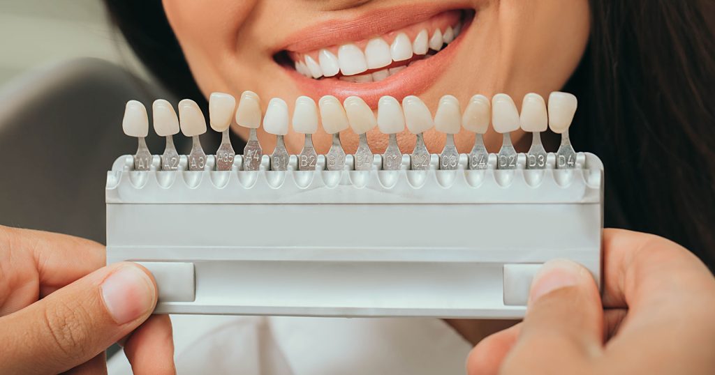 Salud: Mitos sobre el blanqueamiento dental